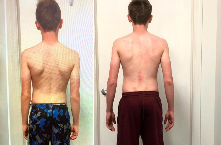 Scoliosis? Don't think so! Total Physical Therapy